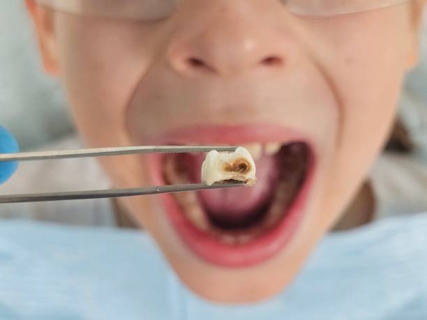 Best Chipped Tooth Repair Near Me  in Maxton, NC